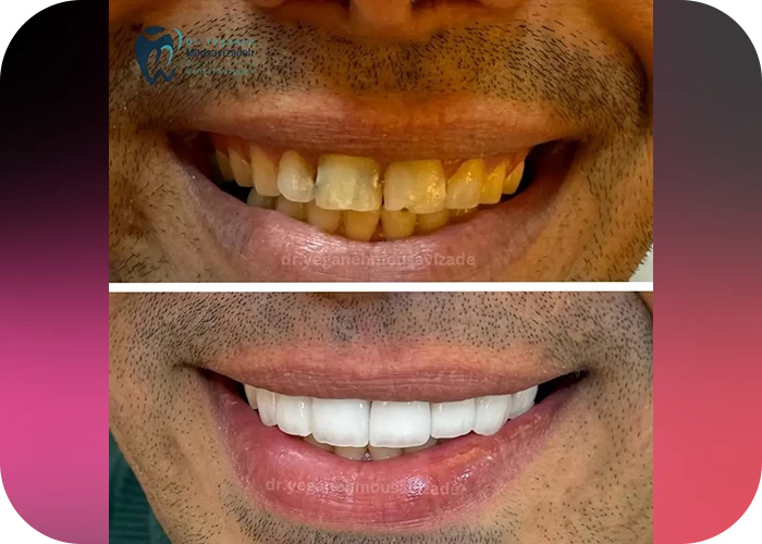 نمونه کار لمینت کلینیک دندانپزشکی دکتر یگانه موسوی زاده - 4