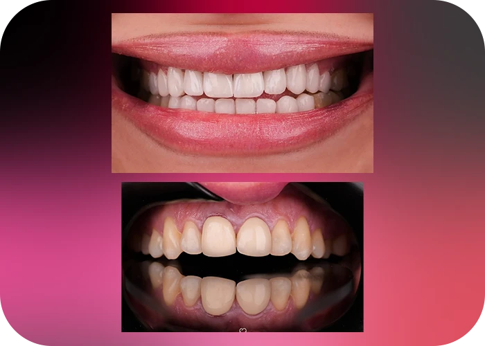 نمونه کار لمینت کلینیک دندانپزشکی بارانا - 3