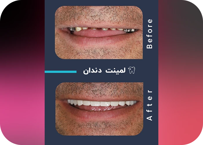 نمونه کار لمینت کلینیک دندانپزشکی بزرگمهر - 1