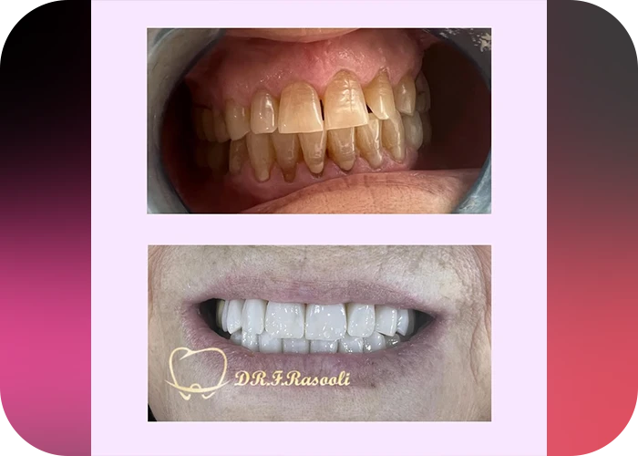 نمونه کار لمینت کلینیک دندانپزشکی دکتر فروزان رسولی - 2