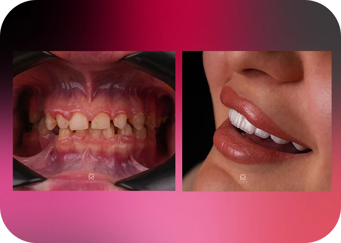 نمونه کار لمینت کلینیک دندانپزشکی بارانا - 1