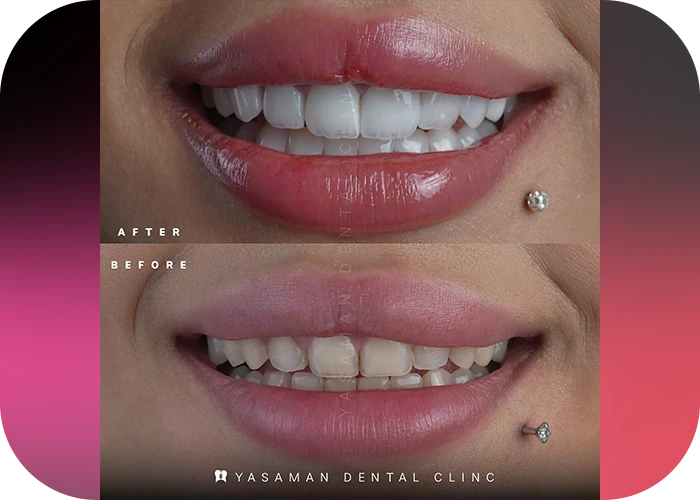 نمونه کار لمینت کلینیک دندانپزشکی یاسمن-1