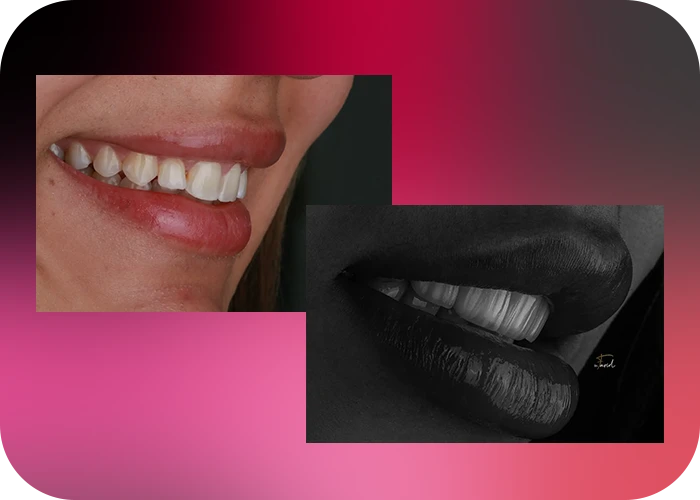 نمونه کار لمینت کلینیک دندانپزشکی دکتر فرید - 4