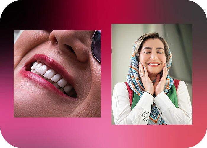 نمونه کار لمینت کلینیک دندانپزشکی دکتر علی عزیزی - 5