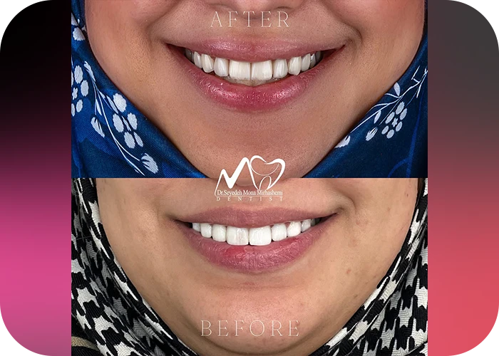 نمونه کار لمینت کلینیک دندانپزشکی دکتر منا میرهاشمی - 4