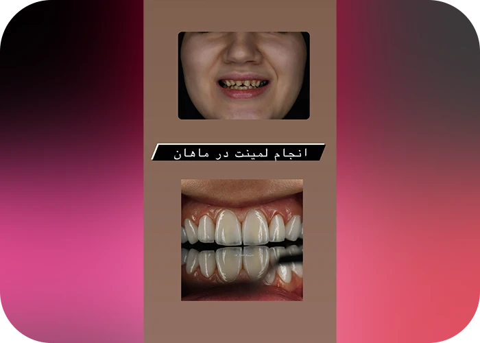 نمونه کار لمینت کلینیک دندانپزشکی ماهان - 1