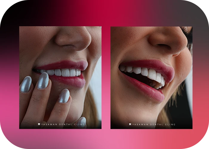 نمونه کار لمینت کلینیک دندانپزشکی یاسمن-4