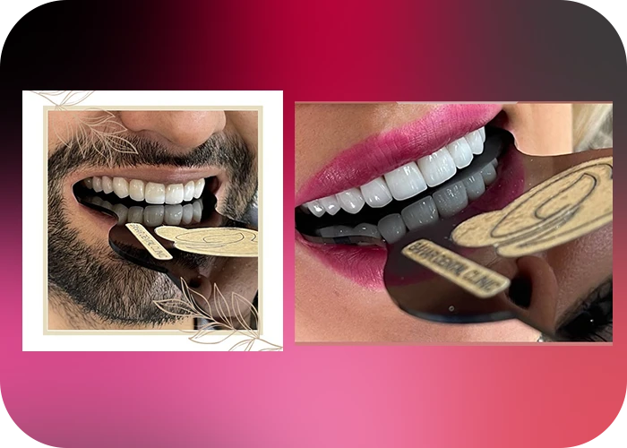 نمونه کار لمینت کلینیک دندانپزشکی بهار - 3