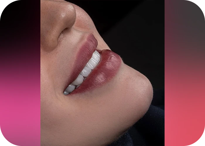 نمونه کار لمینت کلینیک دندانپزشکی ماهان - 4