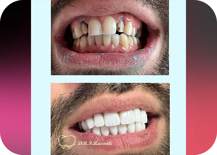 نمونه کار لمینت کلینیک دندانپزشکی دکتر فروزان رسولی - 5