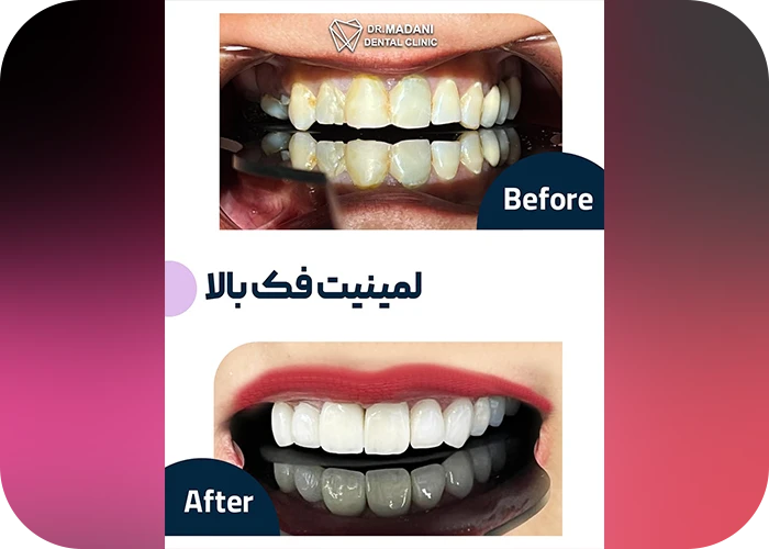 نمونه کار لمینت کلینیک دندانپزشکی دکتر ریحانه معدنی - 1