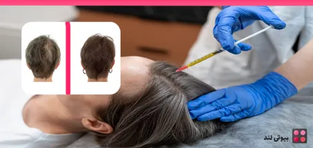 مزوتراپی مو: از تقویت رشد مو تا درمان ریزش