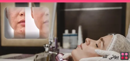 مقایسه جامع بین مزوتراپی و میکرونیدلینگ