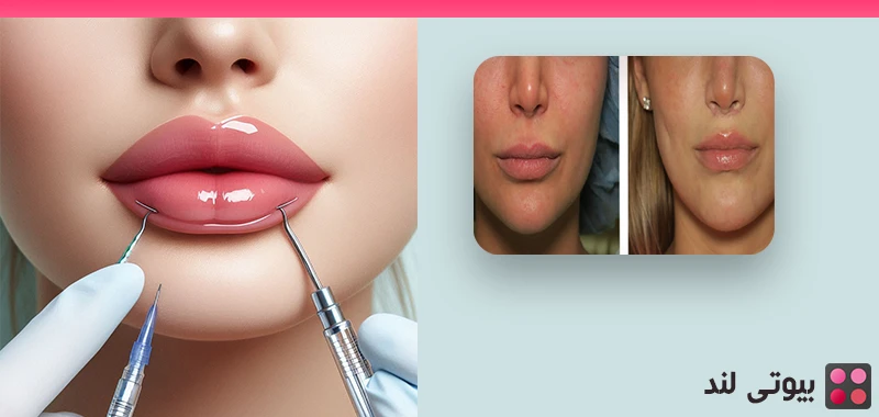 همه چیز درباره جراحی لیفت لب