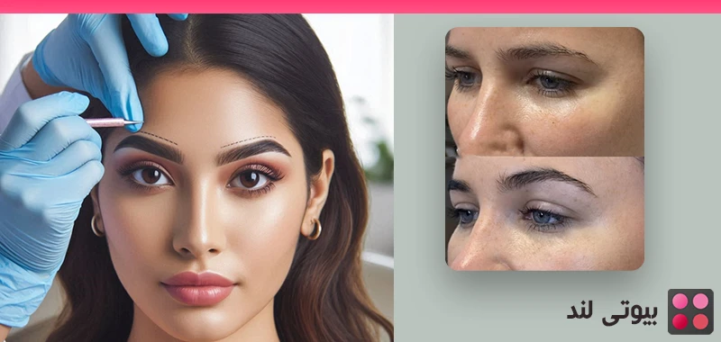 لیفت ابرو چیست؟ جراحی، مزایا و معایب