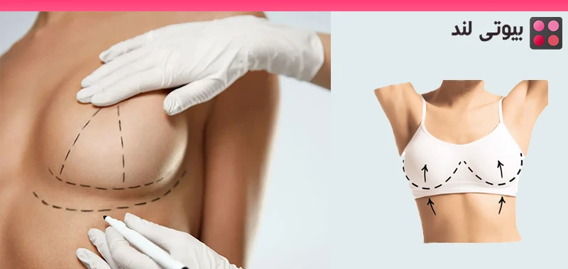 همه چیز درباره جراحی لیفت سینه (ماستوپکسی)
