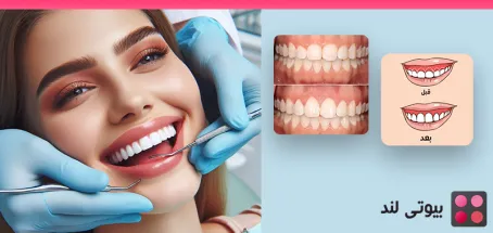 لیفت یا کانتورینگ لثه چیست؟ بررسی مزایا و معایب