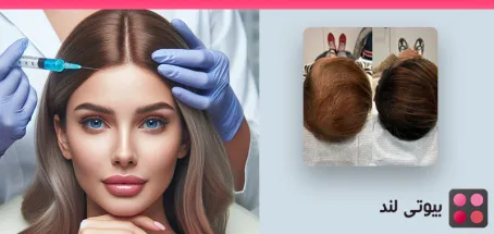 هیر فیلر چیست؟ (Hair Filler) مزایا و معایب