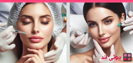 فیلر های چانه چقدر دوام دارند؟