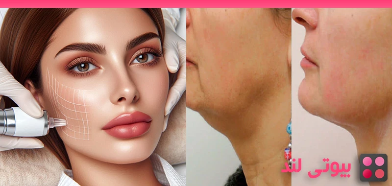 جوانسازی طبیعی صورت، گردن با استفاده از هایفو