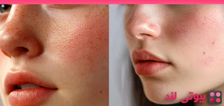 چگونه می توانید آکنه هورمونی را درمان کنید؟