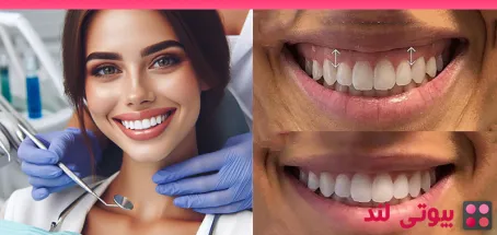 گزینه های محبوب اصلاح لبخند لثه ای