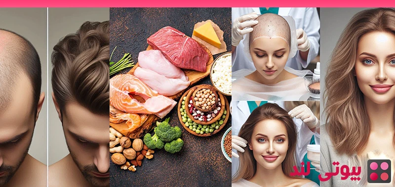 رژیم غذایی بعد از کاشت مو