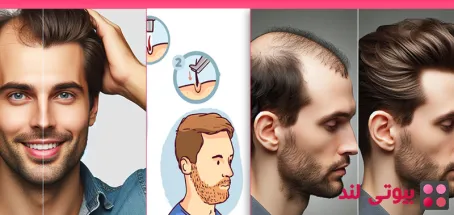 نکاتی که باید قبل از کاشت مو بدانید