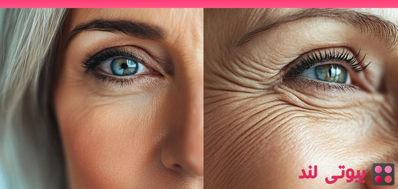 چگونه بدون تزریق از شر چروک دور چشم خلاص شویم؟