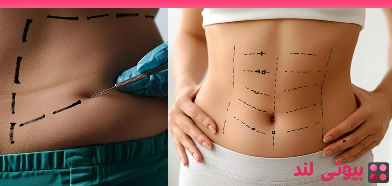 چگونه تورم و کبودی بعد از لیپوساکشن را کاهش دهیم؟