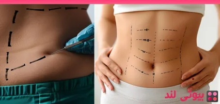 چگونه تورم و کبودی بعد از لیپوساکشن را کاهش دهیم؟