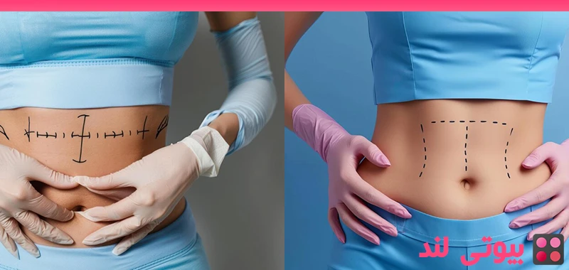 خطرات جراحی ابدومینوپلاستی – آیا تامی تاک بی خطر است؟