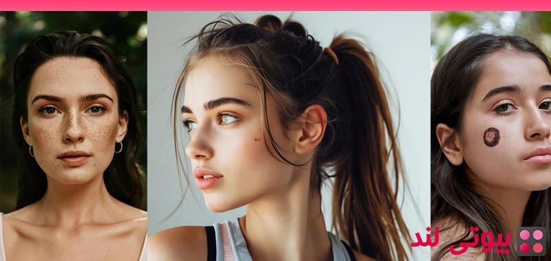 چگونه خال های مادرزادی خود را به روش طبیعی حذف کنیم؟