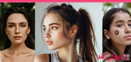 چگونه خال های مادرزادی خود را به روش طبیعی حذف کنیم؟