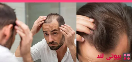 ارتباط دیابت با ریزش مو: علت‌ ها و راه‌ های پیشگیری