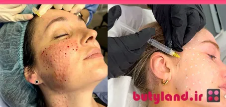 مزوتراپی صورت چیست؟ مزایا، عوارض، هزینه و عکس قبل و بعد