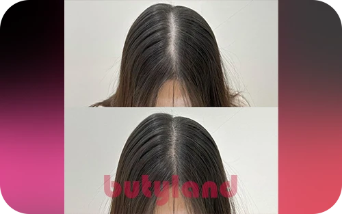راهکار های موثر برای افزایش سرعت رشد مو بعد از کاشت مو