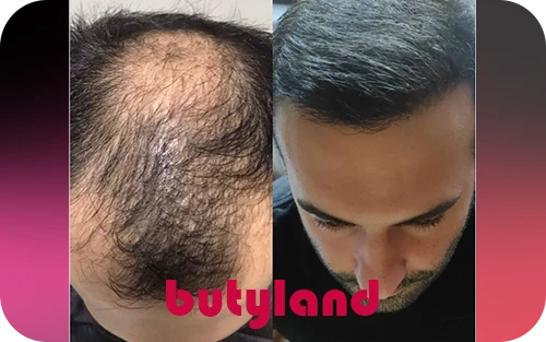 مزایا و معایب کاشت مو FUT: همه‌ چیز درباره این روش