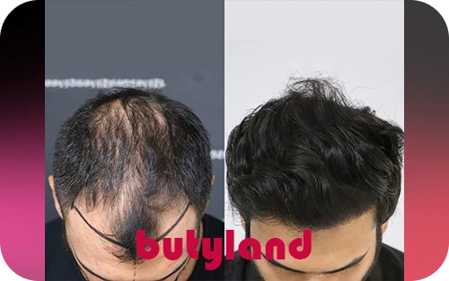تفاوت کاشت موی جراحی و غیرجراحی؛ کدام روش بهتر است؟