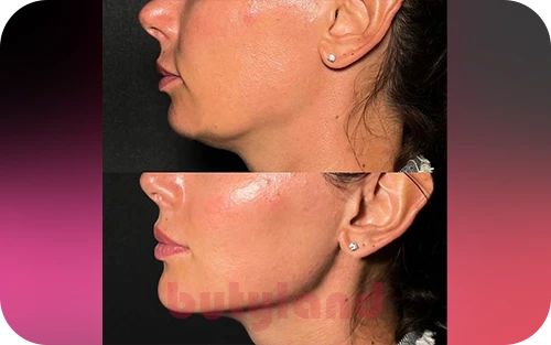 فیلر ترکیبی؛ نسل جدید جوانسازی صورت