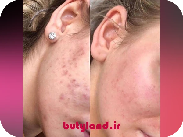 1-مزوتراپی صورت برای لک