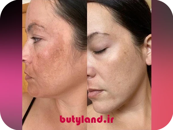 2-مزوتراپی صورت برای لک