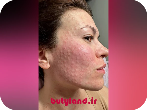 مزوتراپی صورت