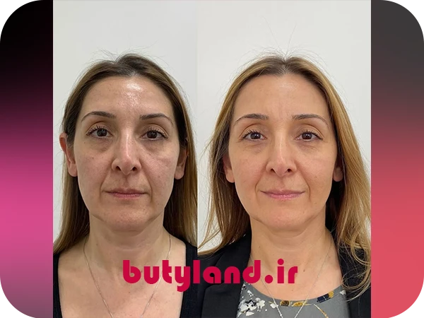 3-عکس قبل و بعد مزوتراپی صورت